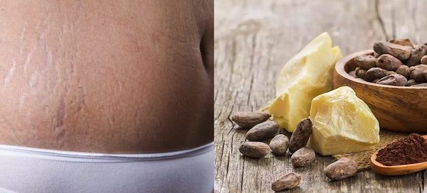 Can you use Cocoa Butter For Scars?