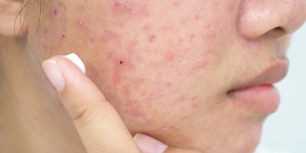 Does Retin A Expire? (And Can You Use Expired Tretinoin Cream?)