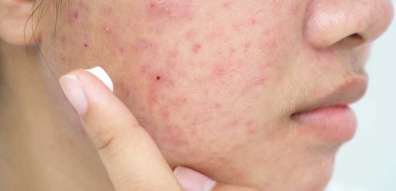 Does Retin A Expire? (And Can You Use Expired Tretinoin Cream?)