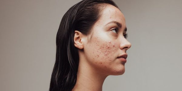 What Happens If You Stop Using Tretinoin Cream (Retin-A)