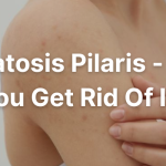 Keratosis Pilaris - How To Get Rid Of It Permanently?